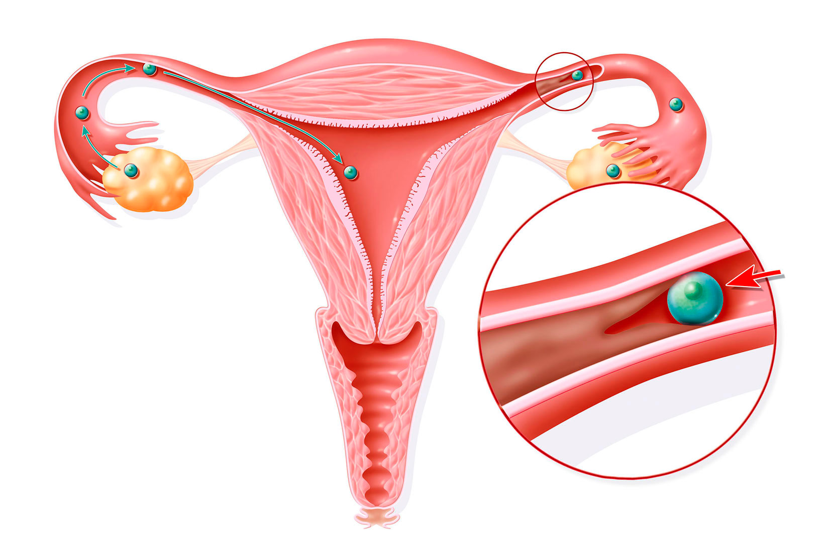 Na slici je prikazan presjek ženskog spolnog organa gdje se vidi da je u jajovodu prisutna smeđa nakupina koja spriječava protok jajne stanice.
