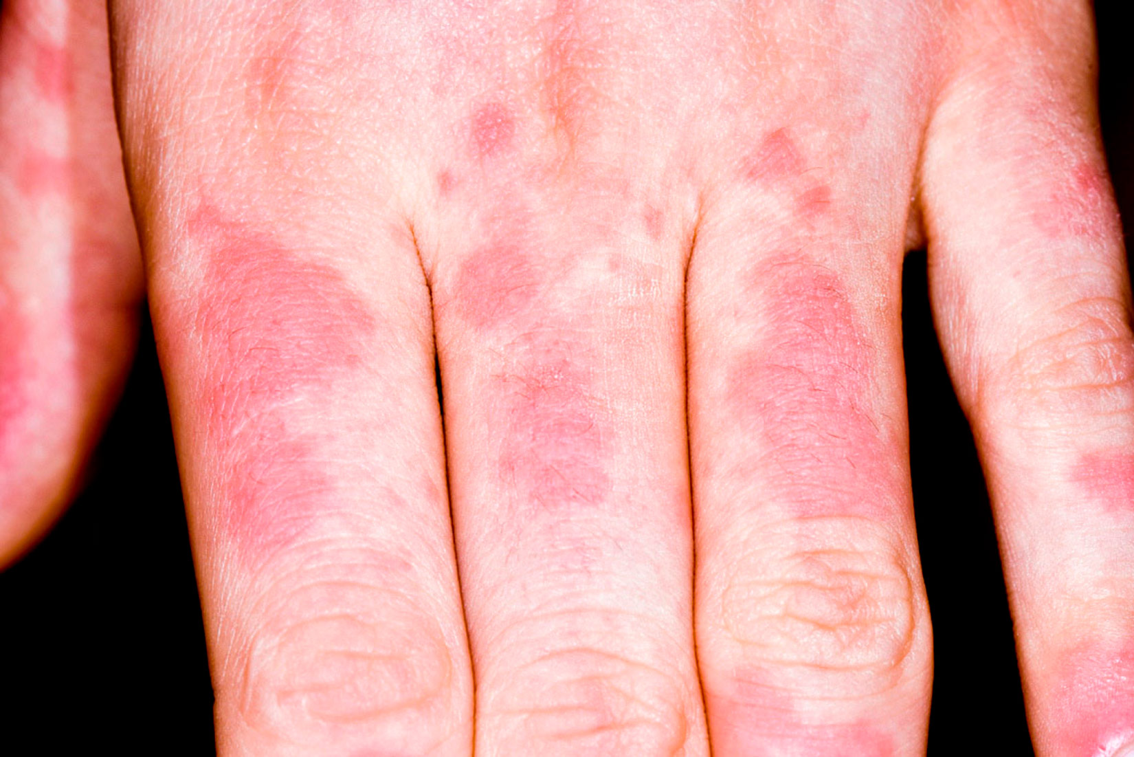 Pojava alergijske reakcije na koži