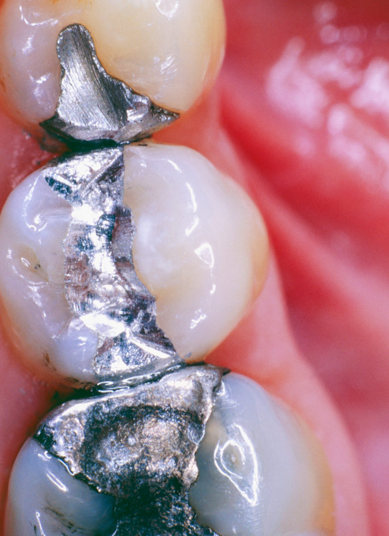 Fotografija prikazuje ljudske zube na kojima su amalgamske plombe srebrnosive boje.