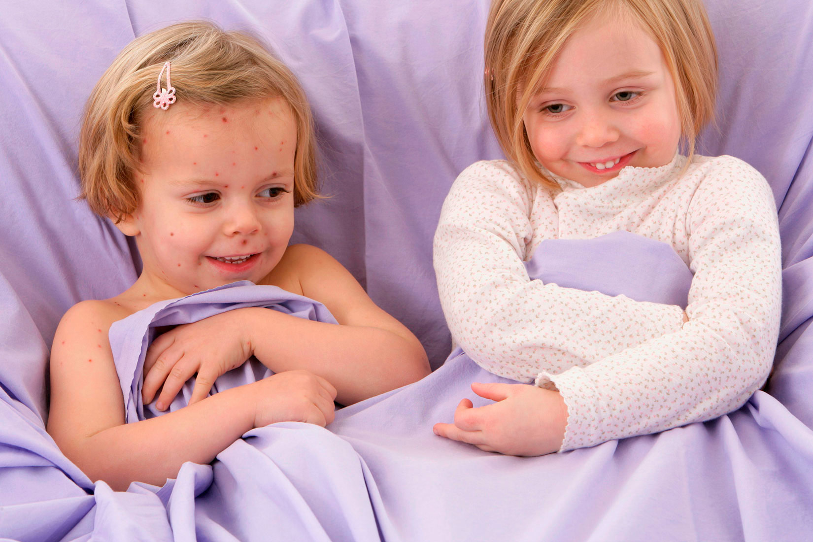 Fotografija prikazuje dvije nasmiješene djevojčice koje leže u krevetu. Jedna djevojčica ima crvene točkice na tijelu -vodene kozice, a druga djevojčica ih nema.