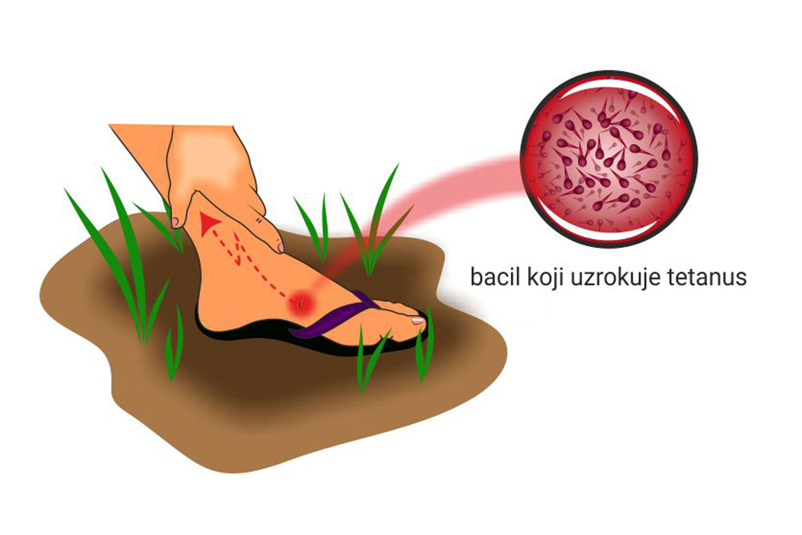 Slika prikazuje povrjeđeno boso stopalo s ranom koja je rizik za zarazu bakterijom tetanusa.